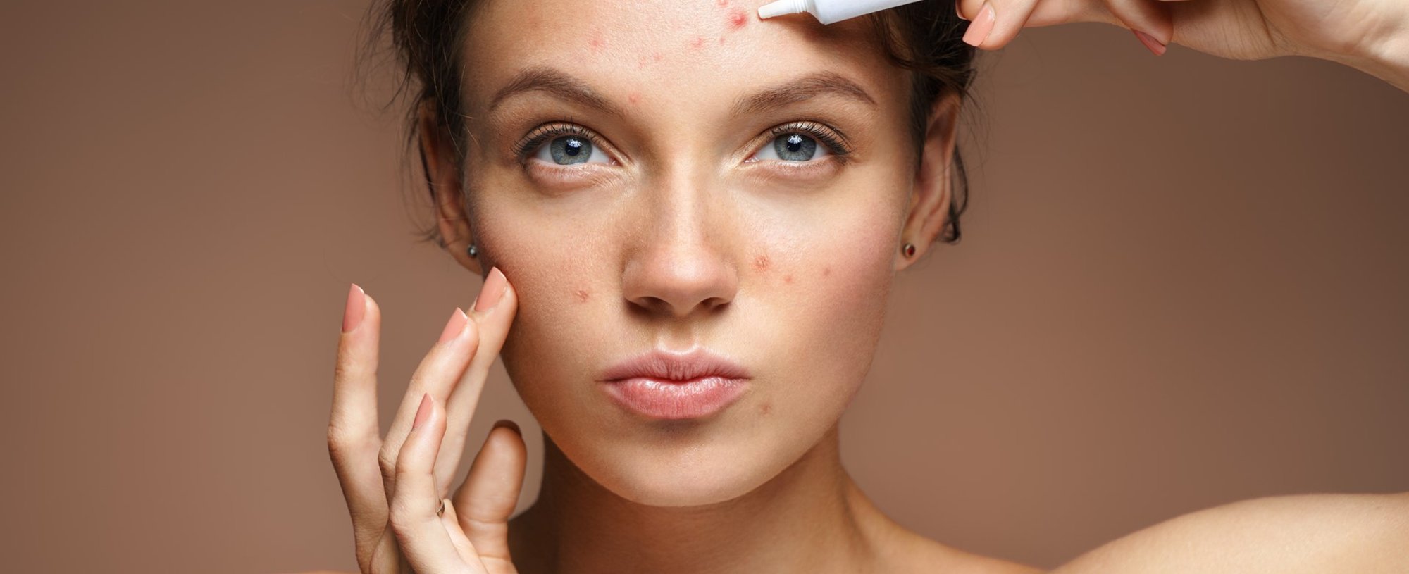 Modelo branca passando produto em acne do rosto