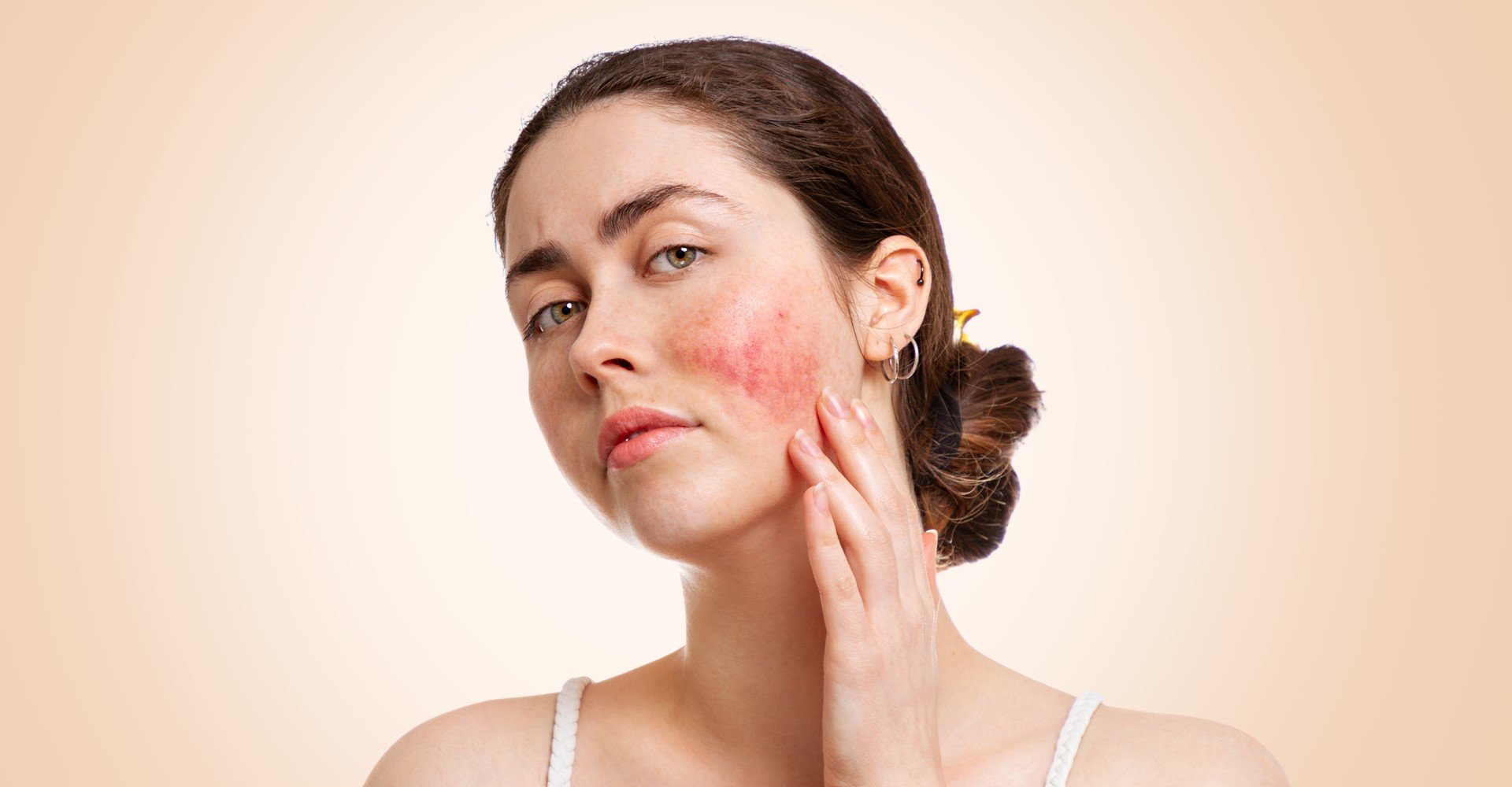 3738 Rosacea Conheca Os 4 Tipos Da Doenca E Saiba Diferenciar Os Sintomas Na Pele Do Rosto