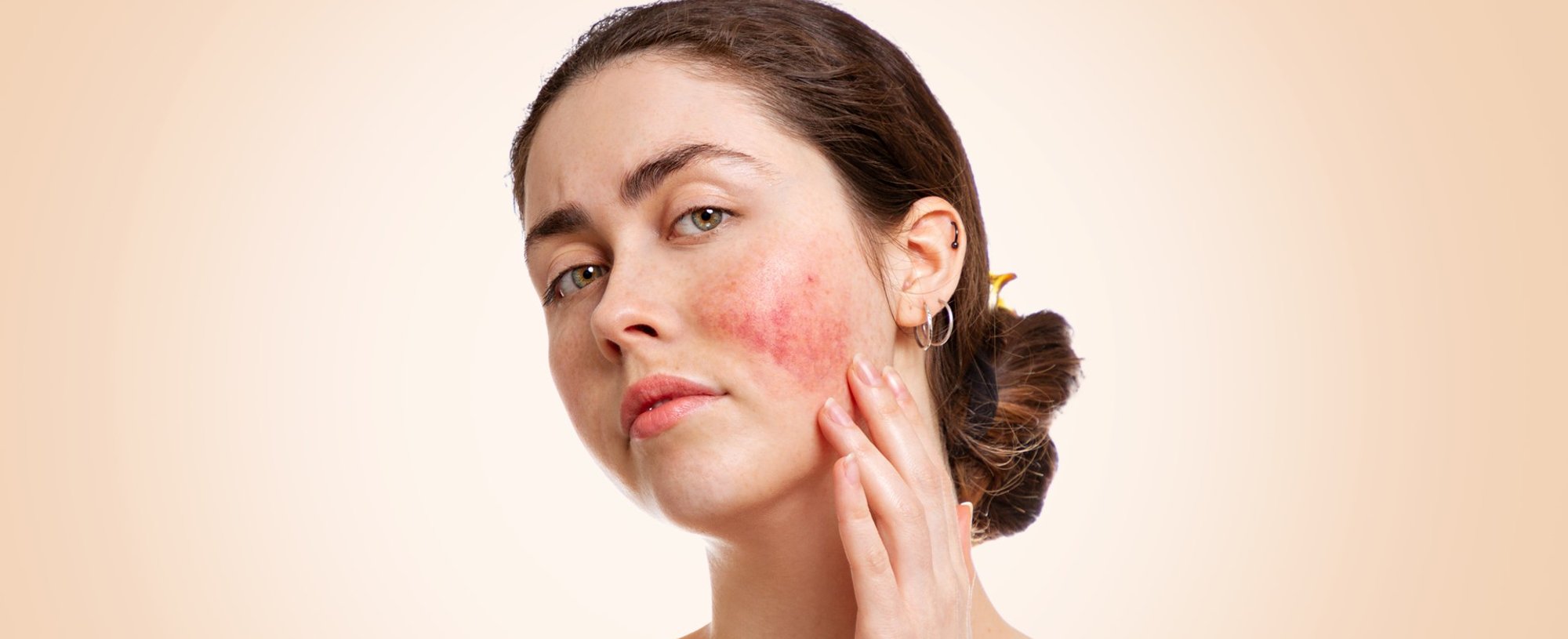 3738 Rosacea Conheca Os 4 Tipos Da Doenca E Saiba Diferenciar Os Sintomas Na Pele Do Rosto