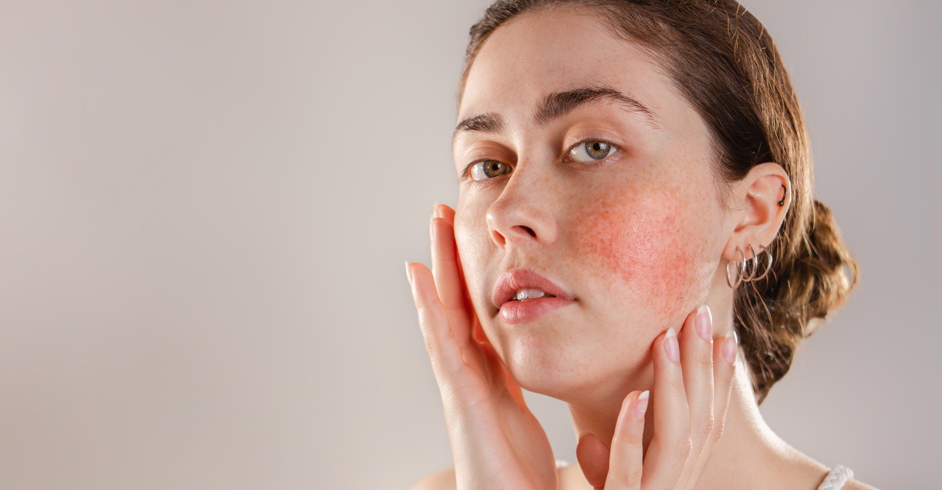 3853 Por Que A Rosacea Aparece Saiba Quais Sao Os 7 Fatores Que Pioram A Vermelhidao No Rosto