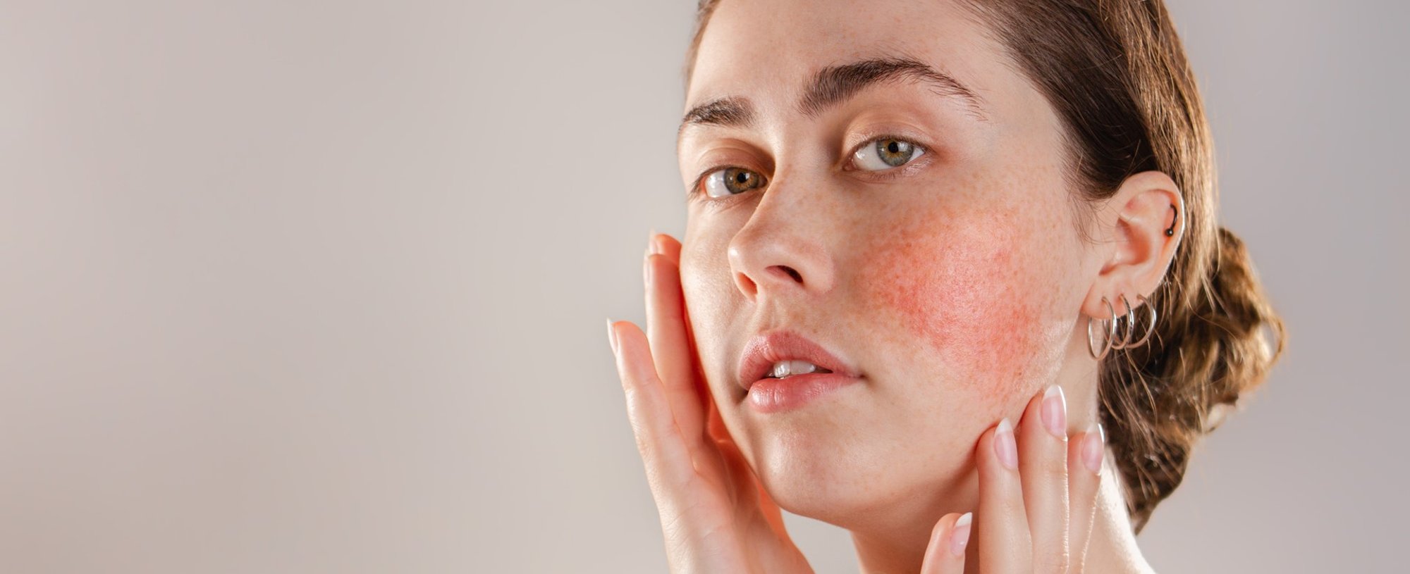 3853 Por Que A Rosacea Aparece Saiba Quais Sao Os 7 Fatores Que Pioram A Vermelhidao No Rosto