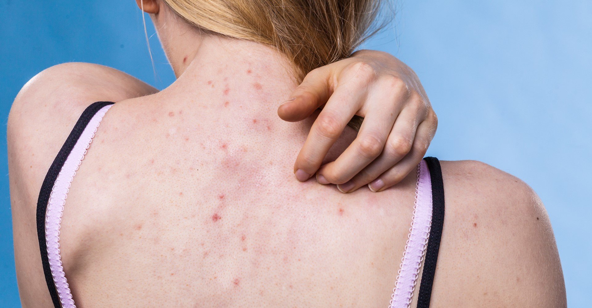 Modelo branca com espinhas nas costas