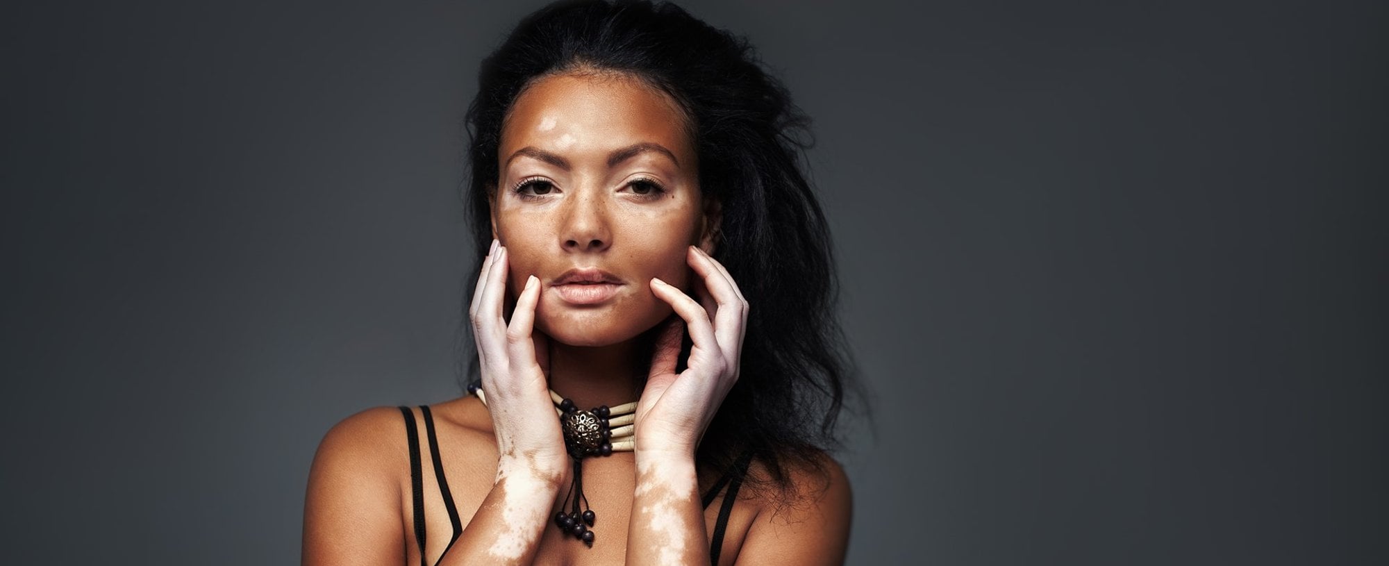 Modelo com manchas de vitiligo no corpo