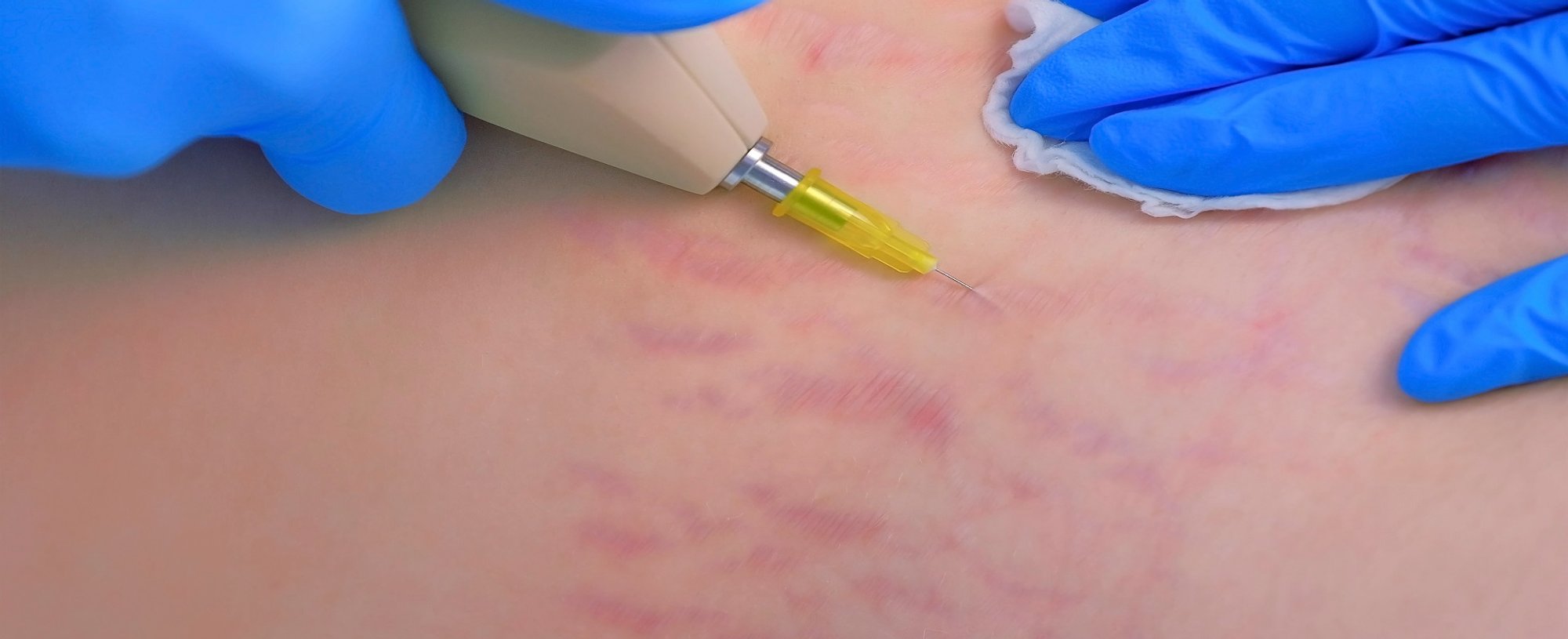 Carboxiterapia O Que E Saiba