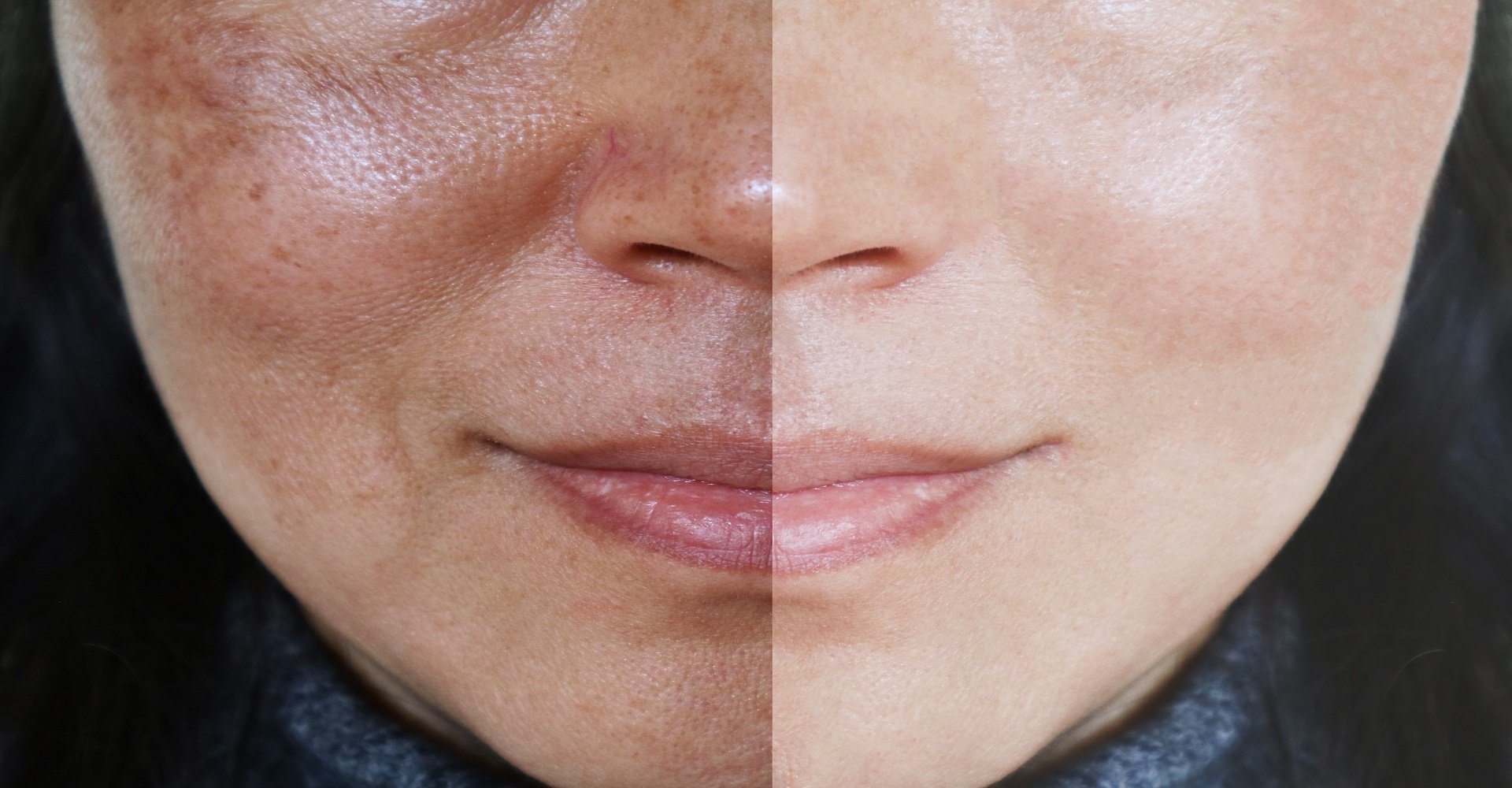 Como tirar manchas do rosto causadas pelo sol? | L'Oréal Paris