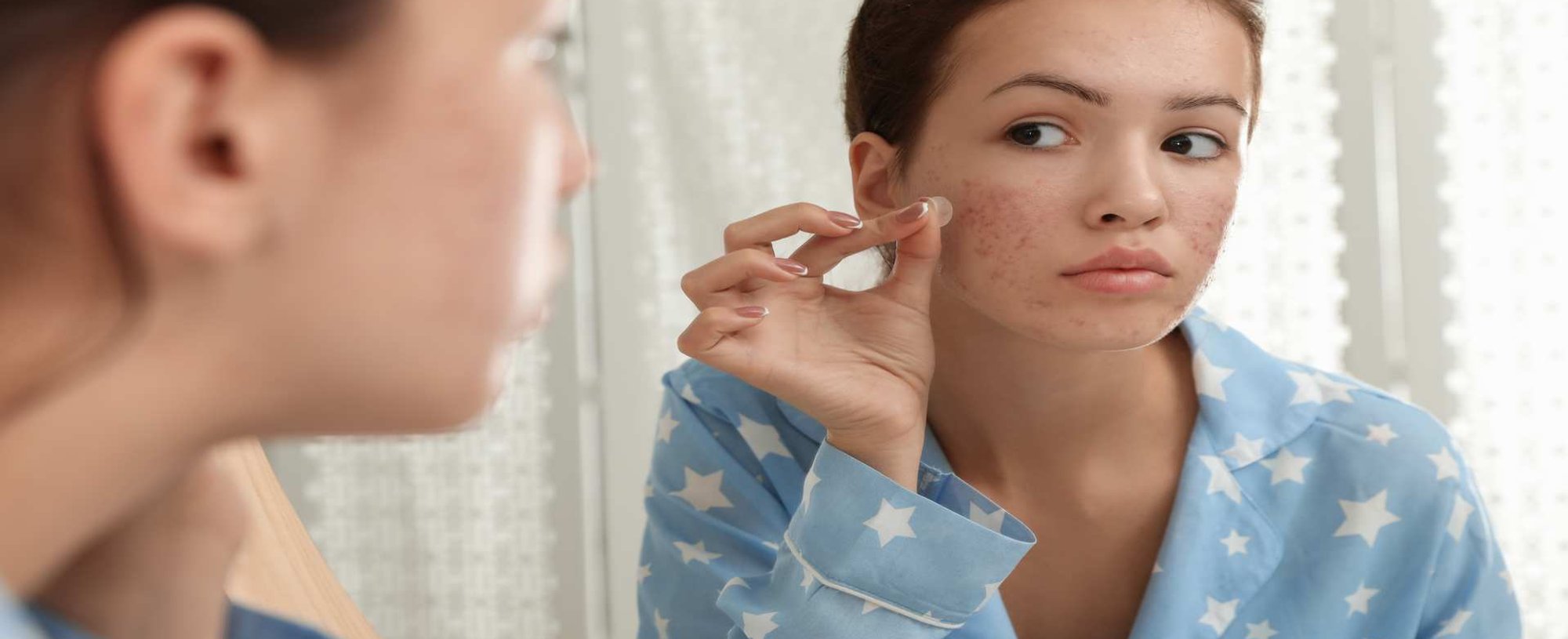 Modelo Com Acne No Rosto