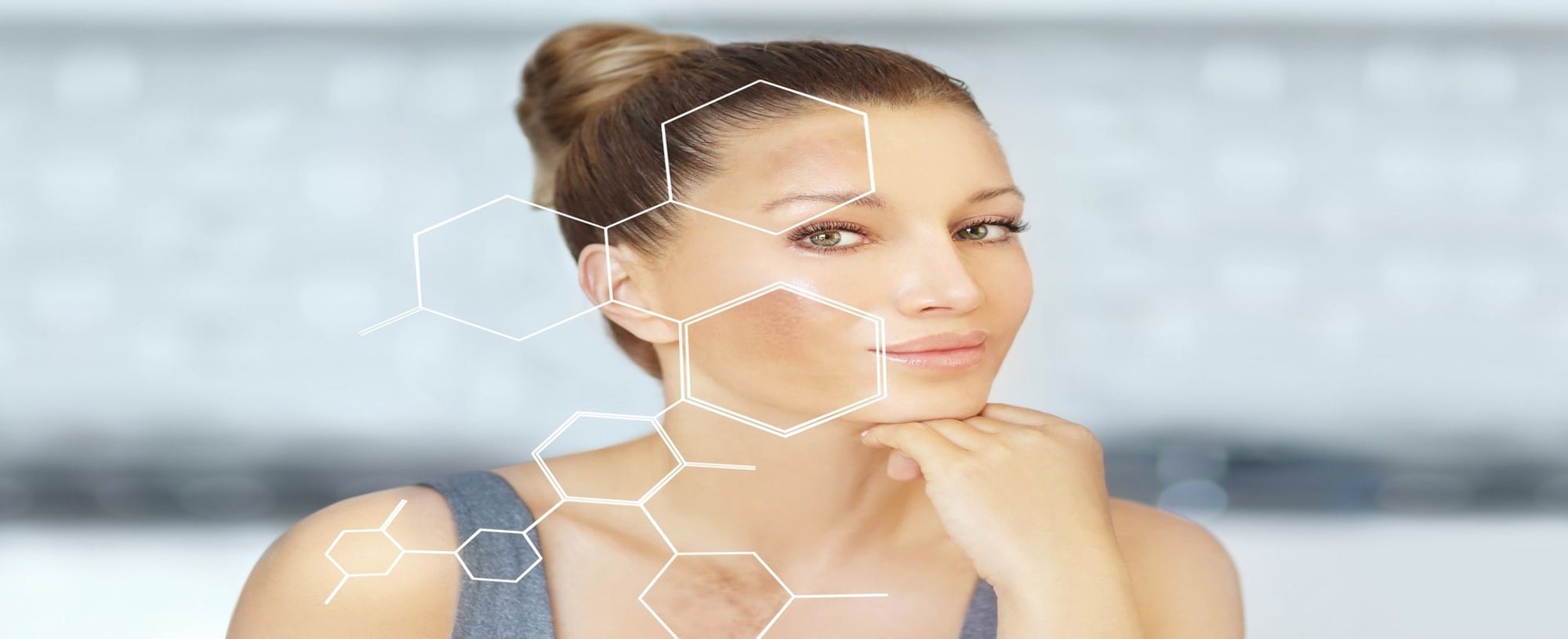 Modelo Com Melasma