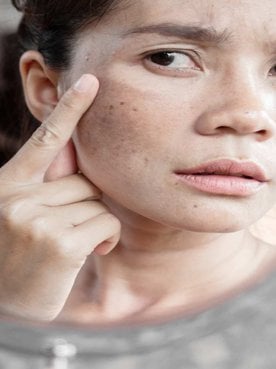 Mulher Se Olhando No Espelho Com Mancha No Rosto
