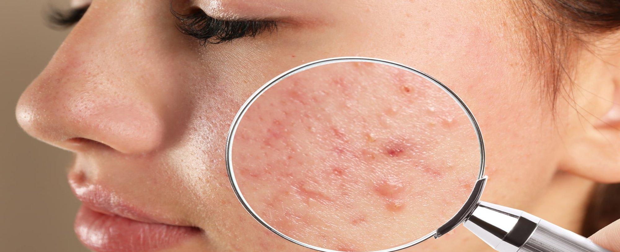 Rosto Com Acne