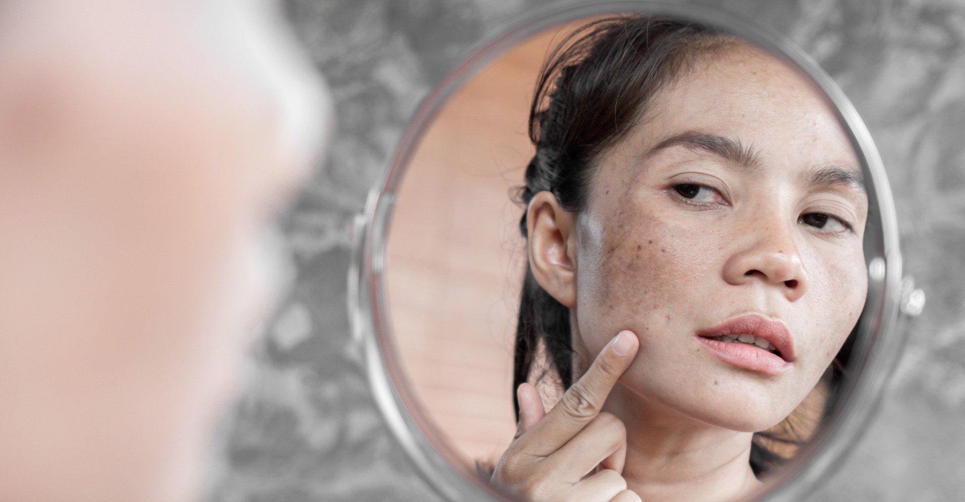 Mulher Observando As Manchas Em Sua Pele