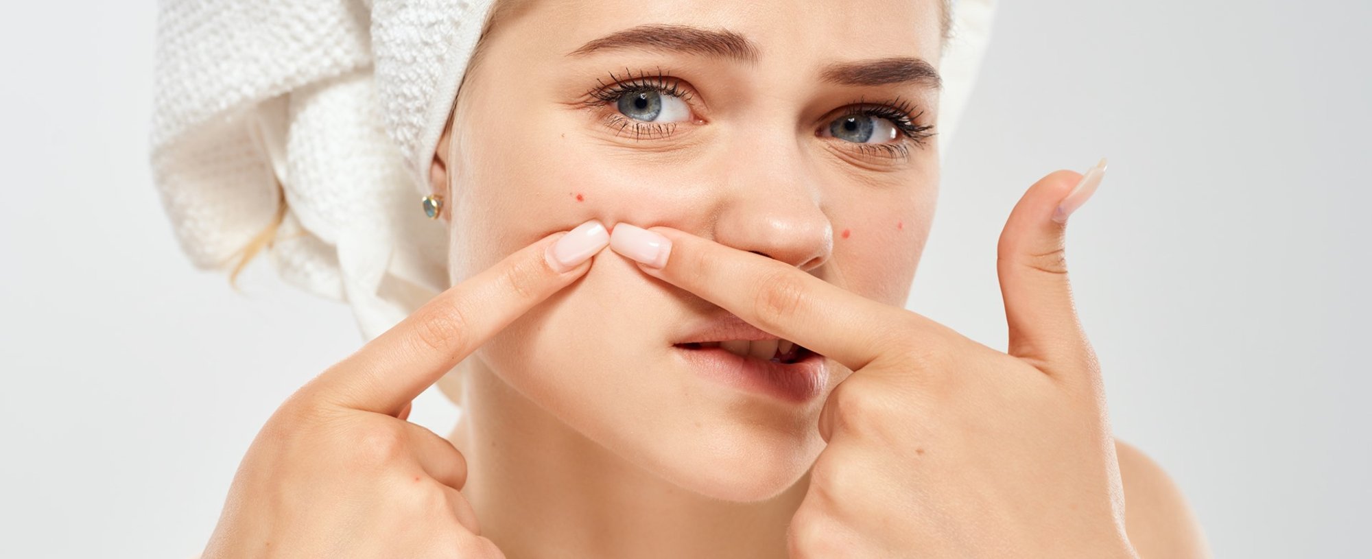 Modelo branca com acnes no rosto