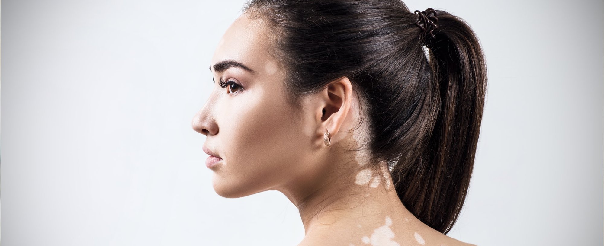 2606 Pele Com Vitiligo Como Cuidar Em Casa Dermatologista Explica