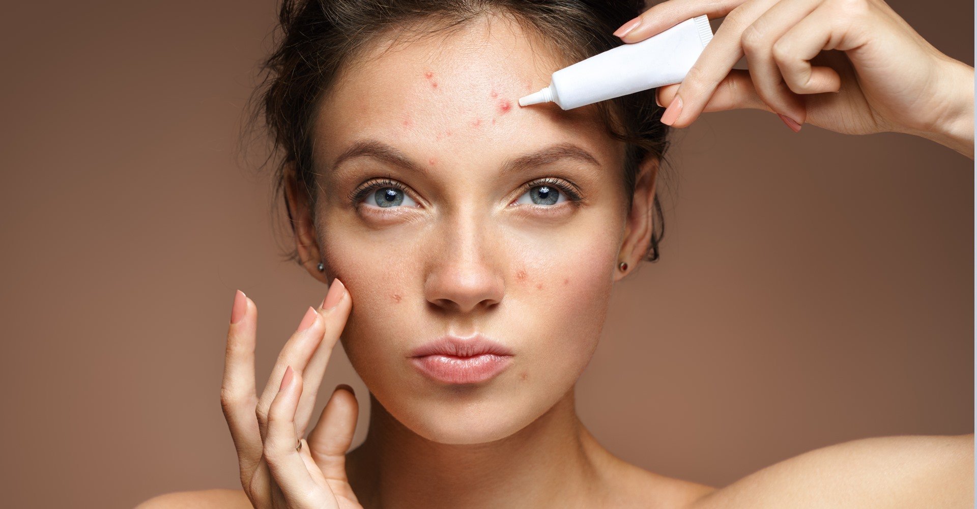 Como tirar cicatrizes de espinhas? Veja os tratamentos mais indicados