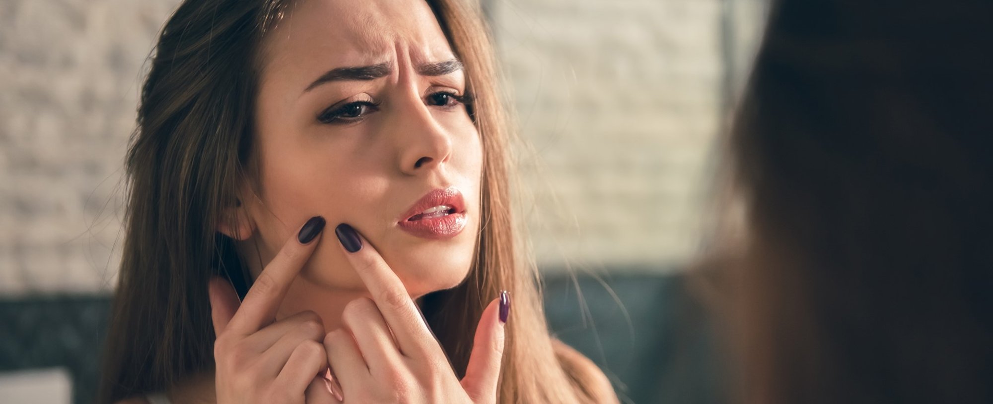 2864 Pele Com Acne Saiba Como Identificar E Tratar Todos Os Tipos De Acne