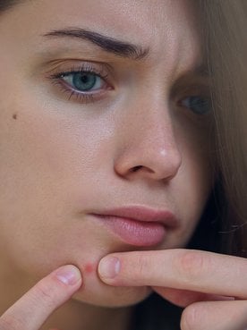 Modelo branca olhando pelo espelho acne em seus rosto