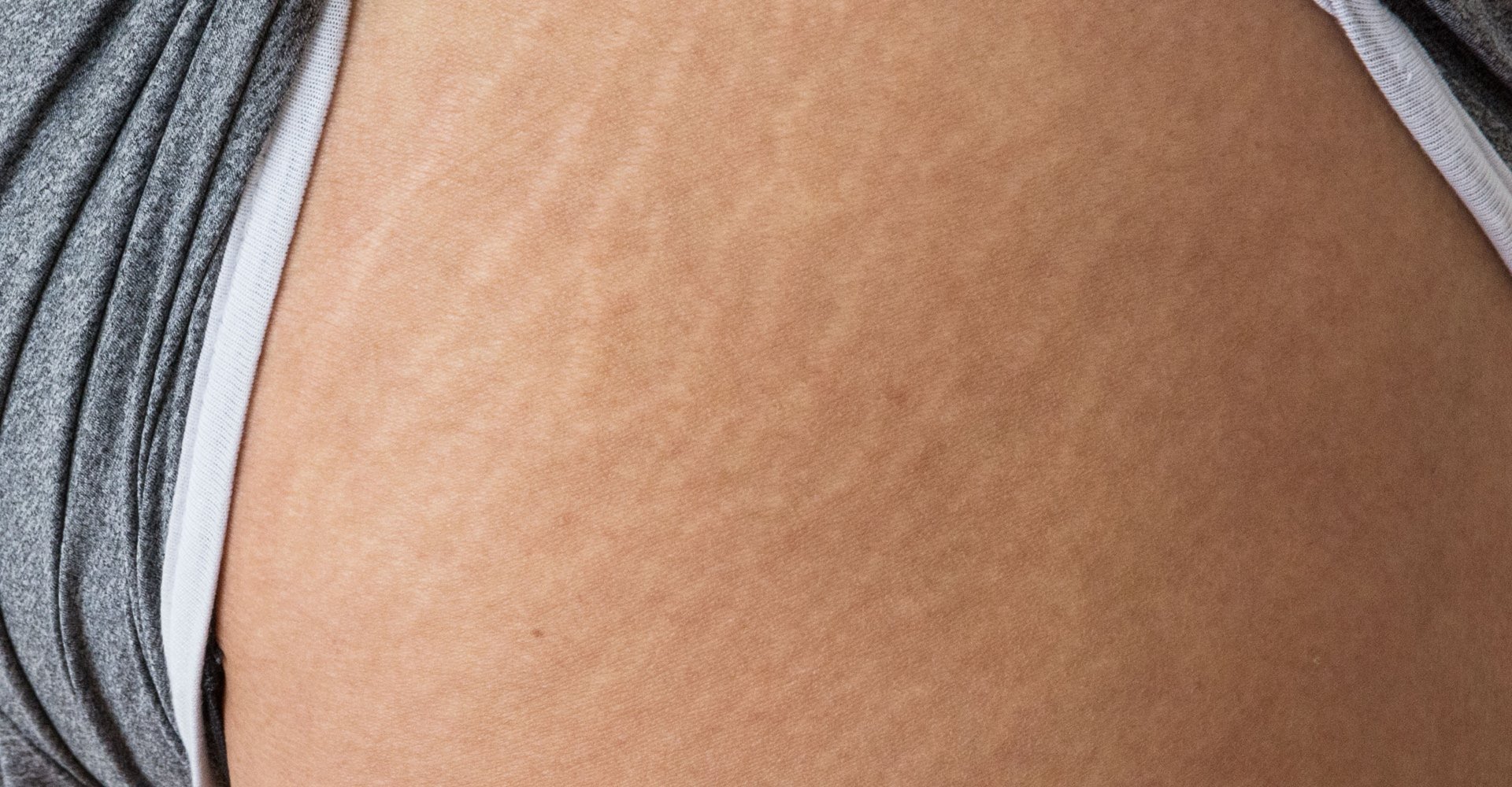 Imagem de uma parte do corpo com estrias