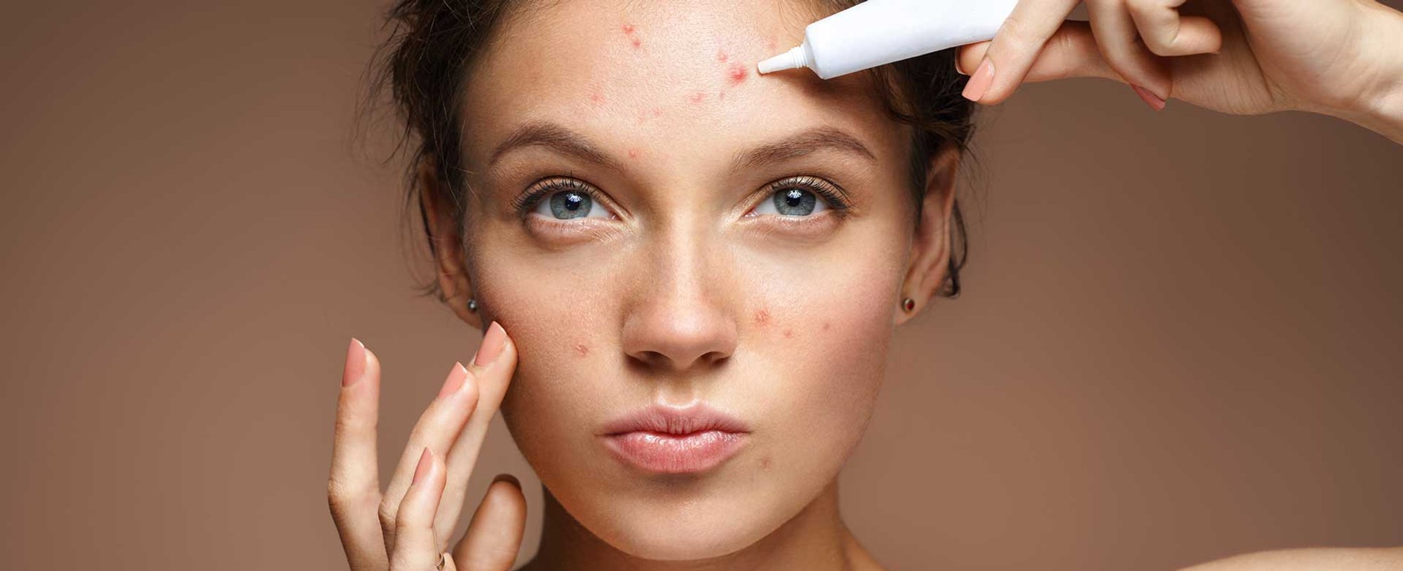 Mulher passando produto para tratar suas espinhas