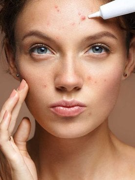 Mulher passando produto para tratar suas espinhas