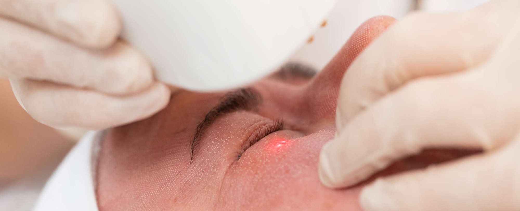 cirurgia estética a laser