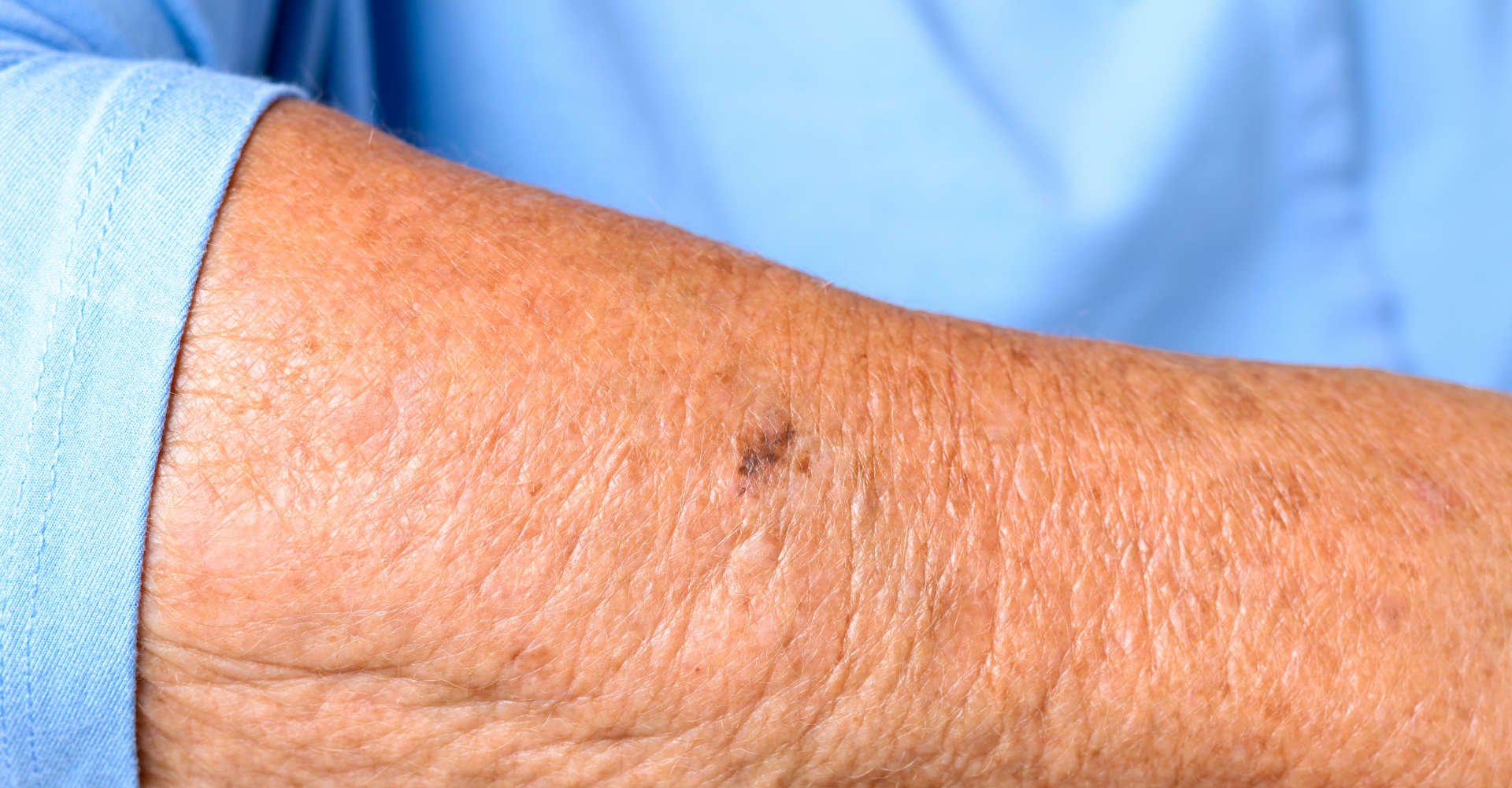 braço com pele enrugada 