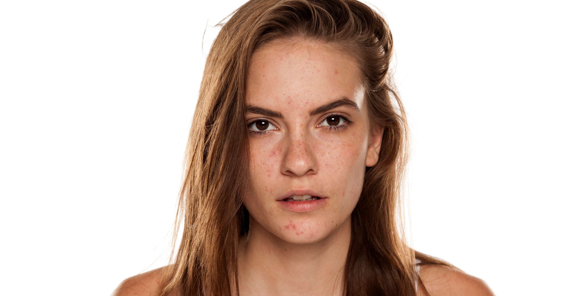 mulher exibe rosto com manchas 