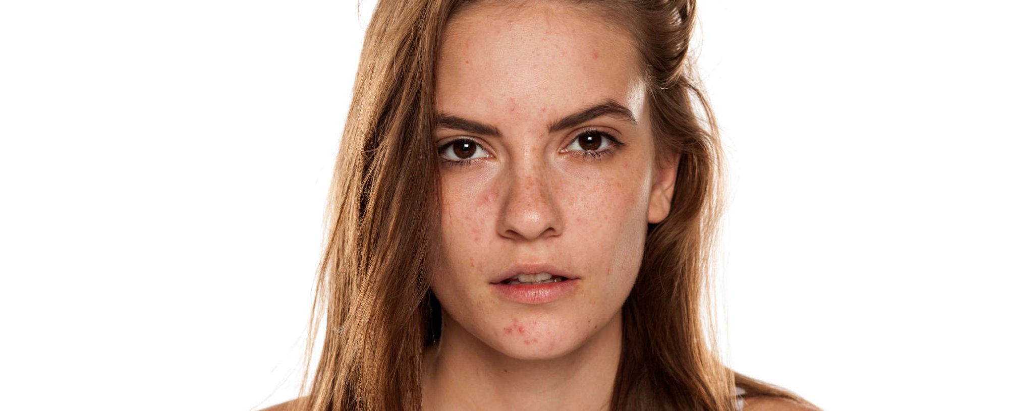 mulher exibe rosto com manchas