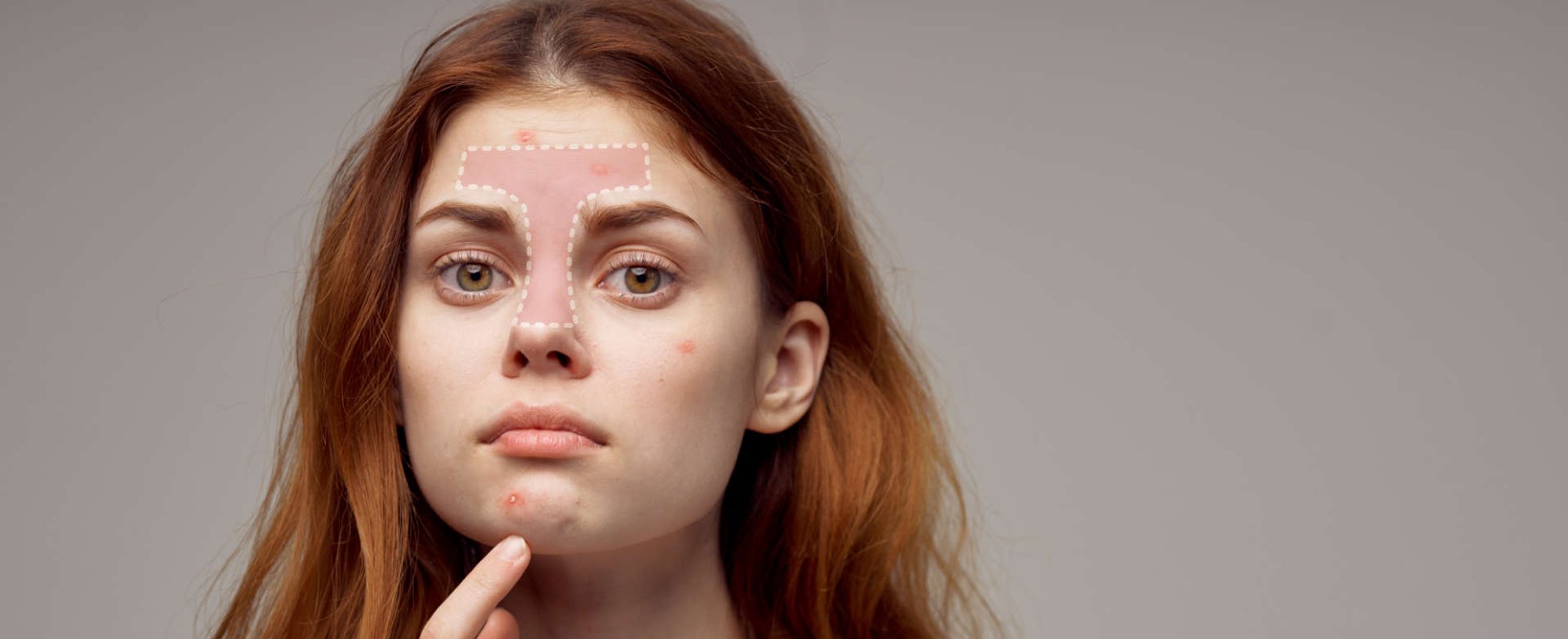 mulher exibe acne na zona T do rosto