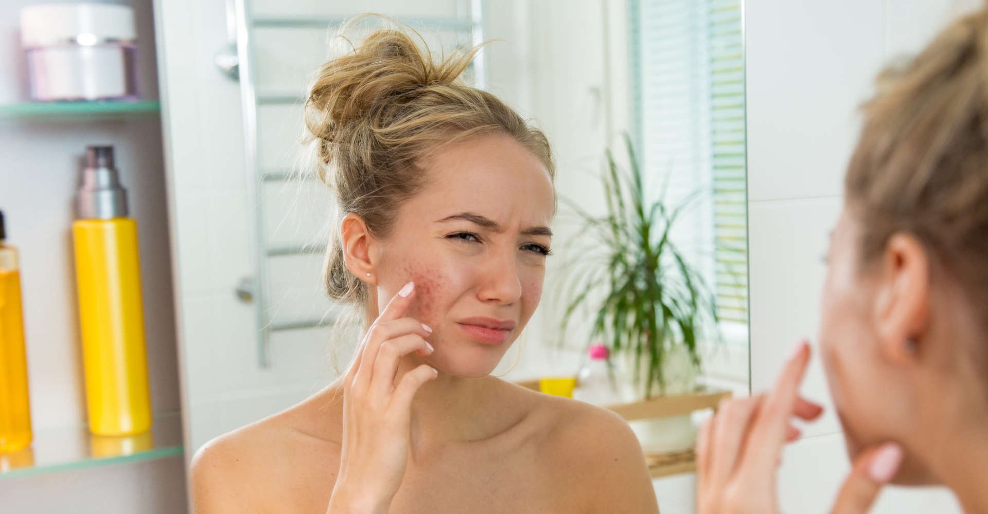 mulher estressada com espinhas na pele