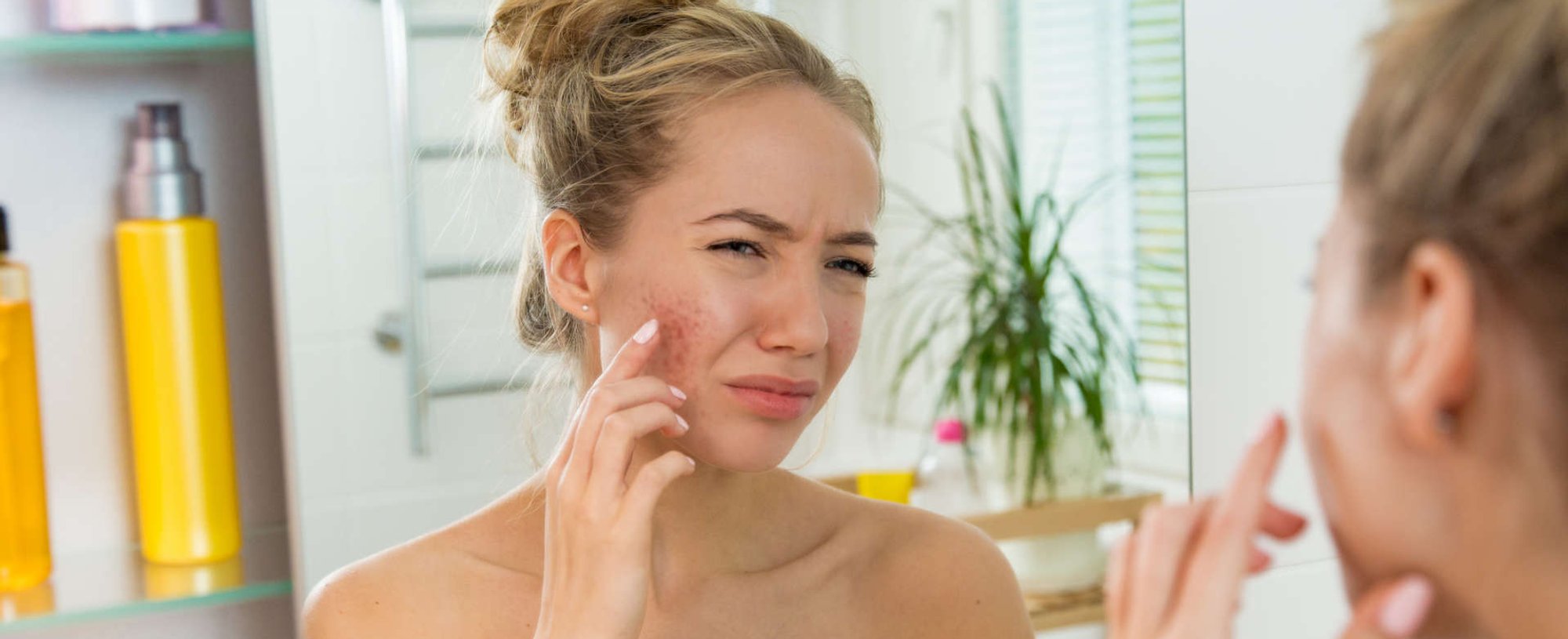 mulher estressada com espinhas na pele