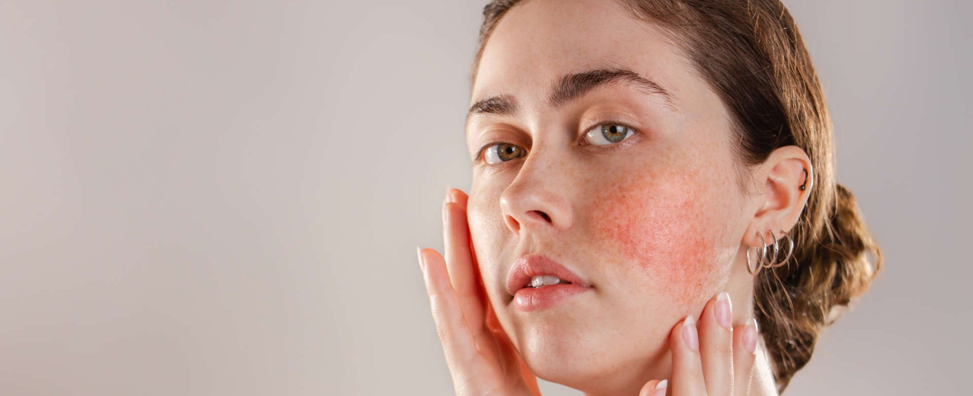 mulher exibe pele com rosácea