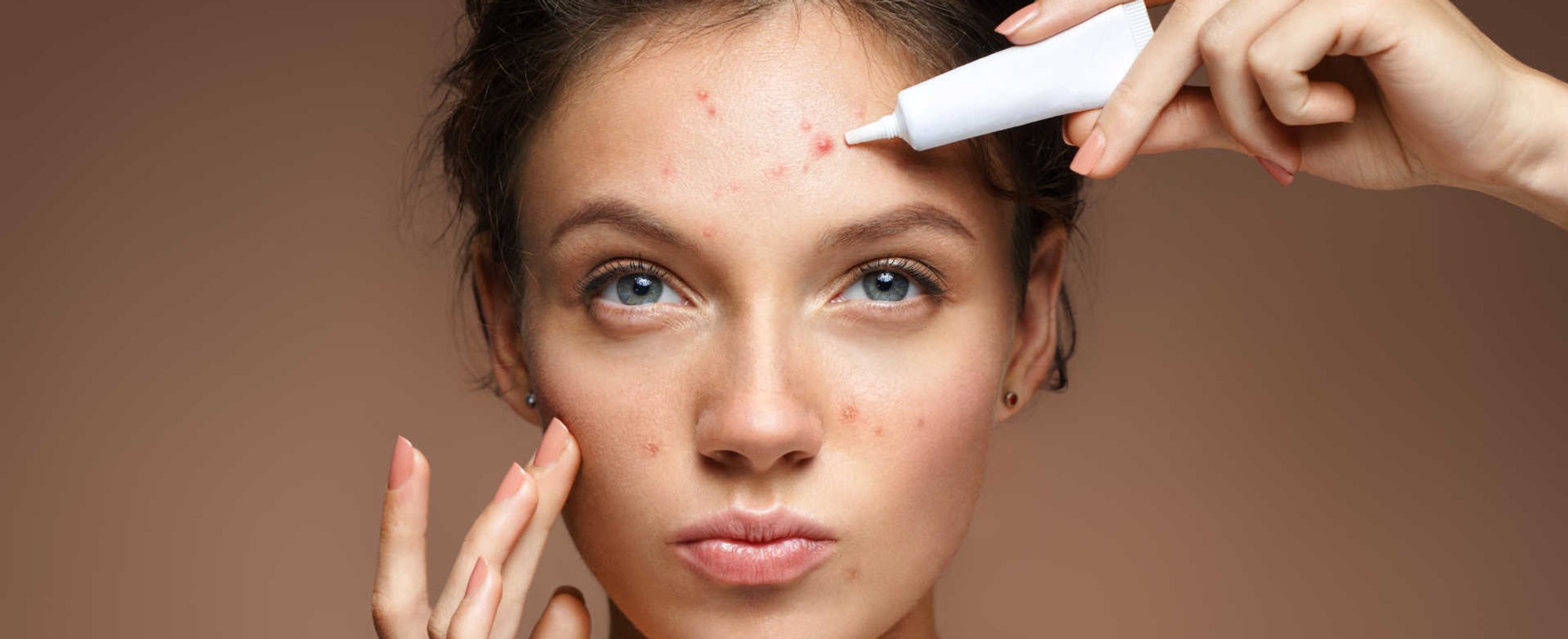 Modelo branca passando creme em acnes do rosto