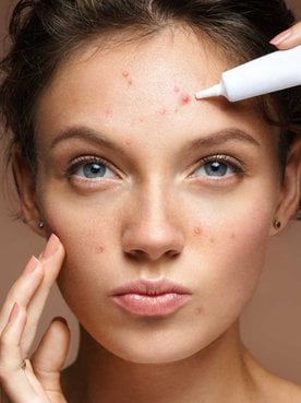Modelo branca passando creme em acnes do rosto