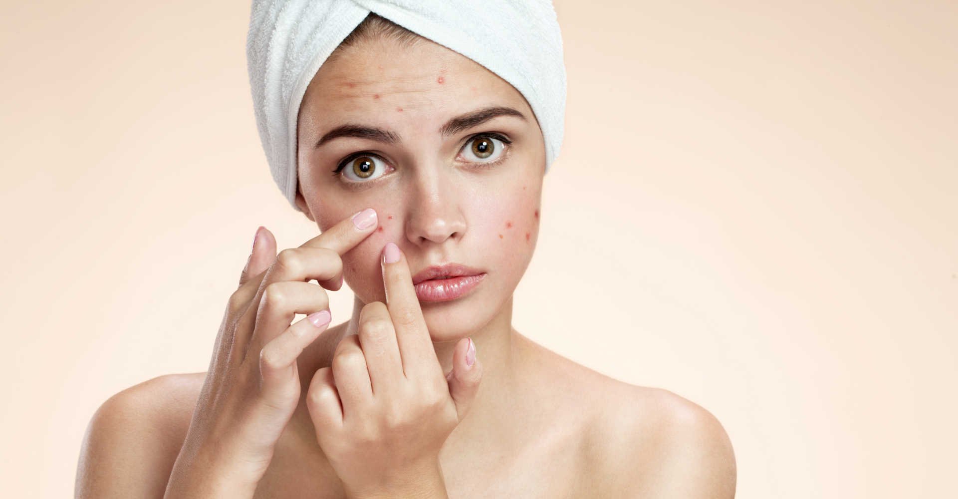 Modelo branca com acnes no rosto