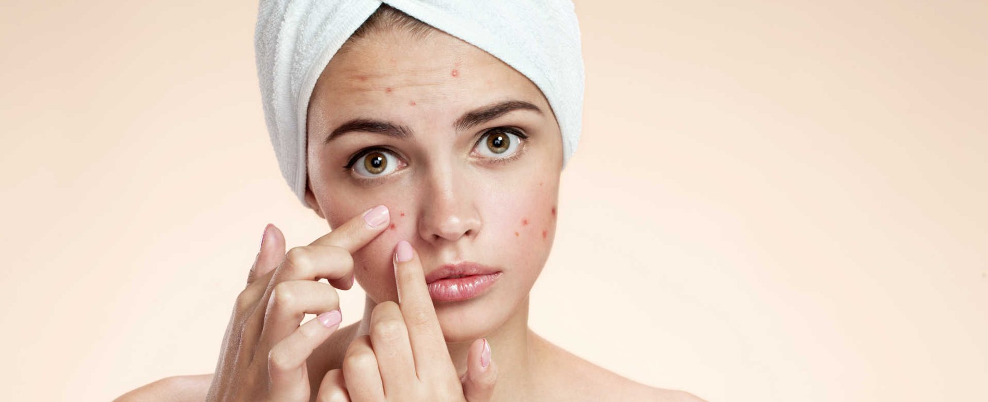 Modelo branca com acnes no rosto