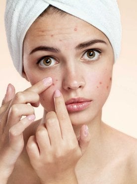 Modelo branca com acnes no rosto
