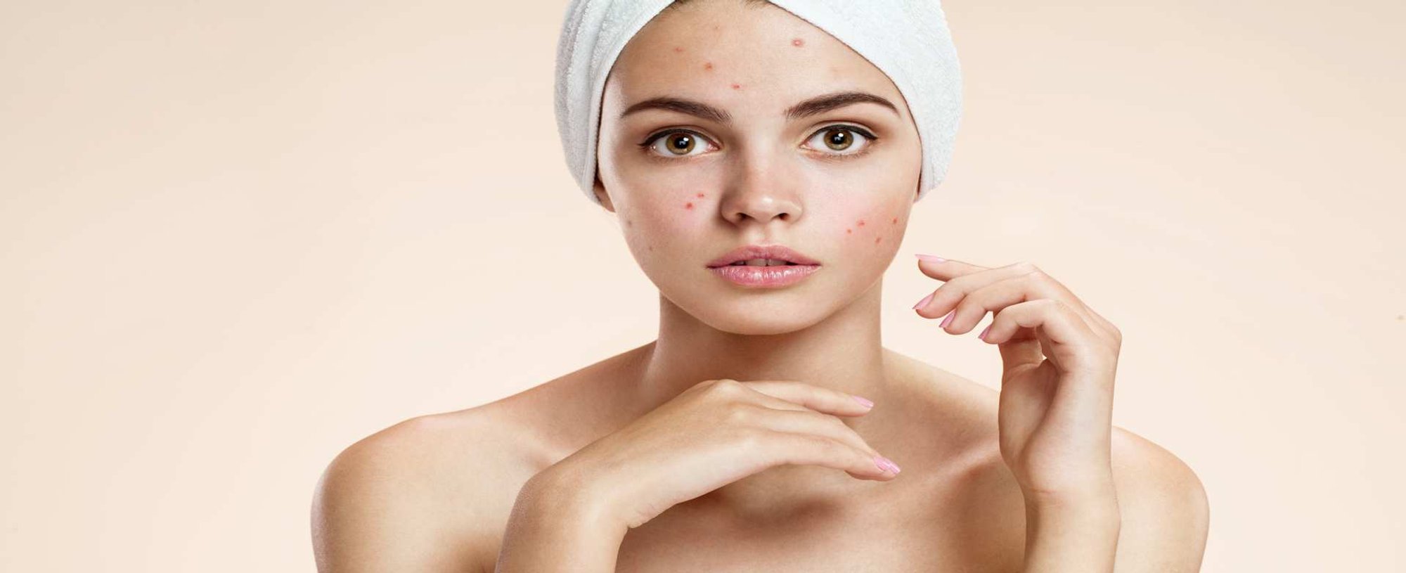 Modelo com acnes no rosto