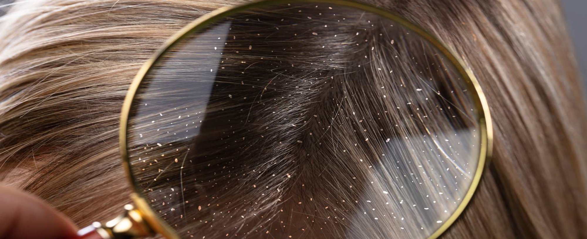1879 Cabelo Com Caspa Pode Ser Colorido
