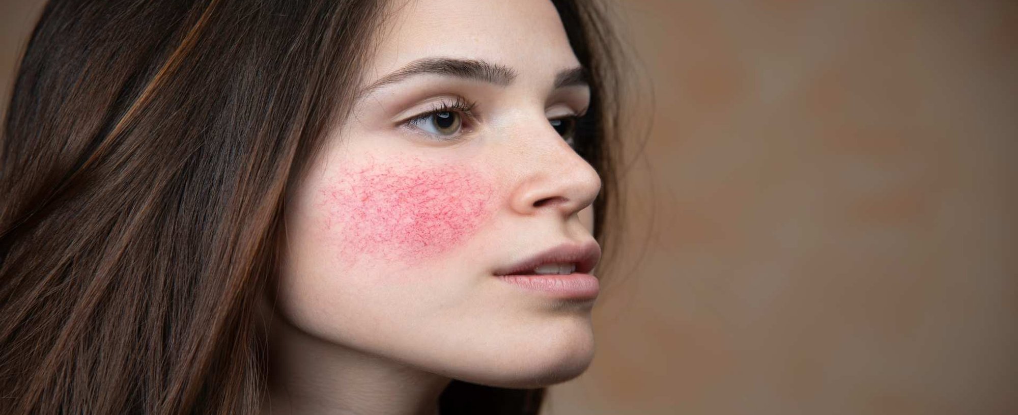 1884 Como Saber Se Eu Tenho Rosacea