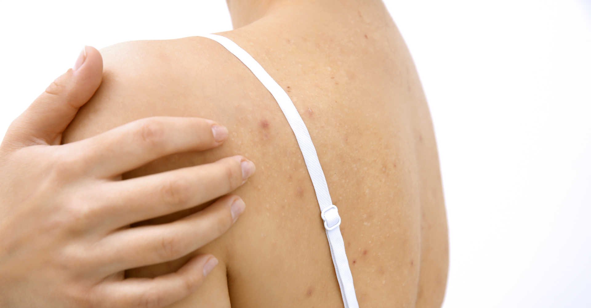 2478 Espinha Nas Costas Confira 6 Formas De Evitar As Inflamacoes