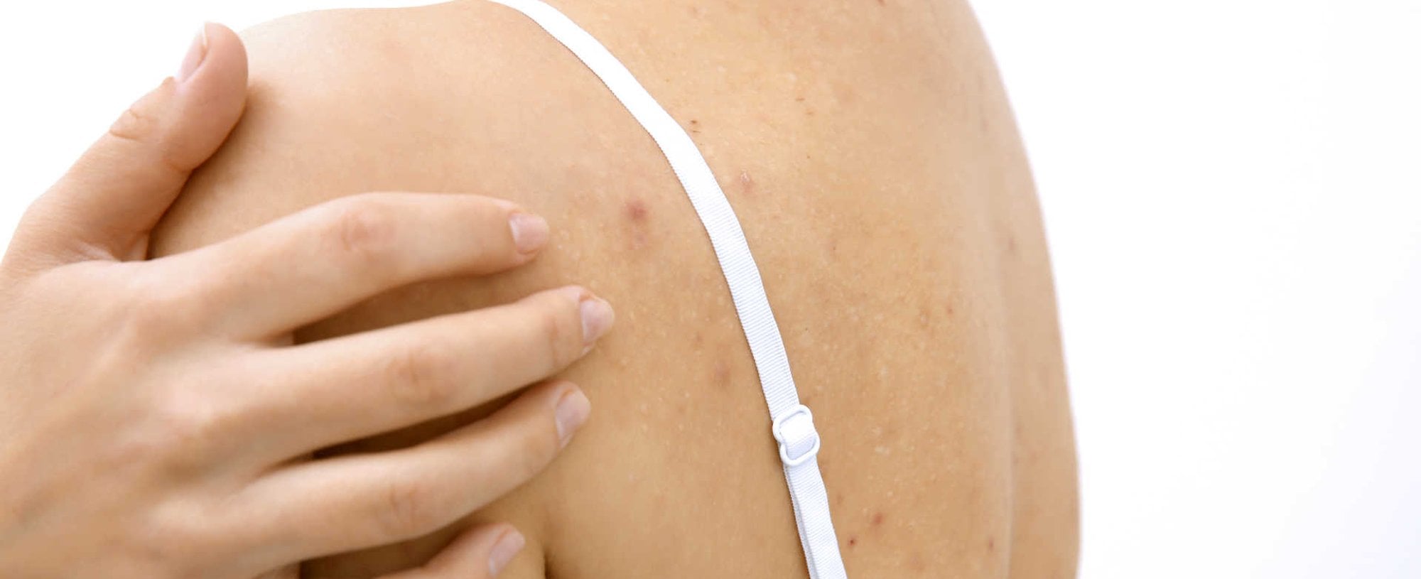 2478 Espinha Nas Costas Confira 6 Formas De Evitar As Inflamacoes