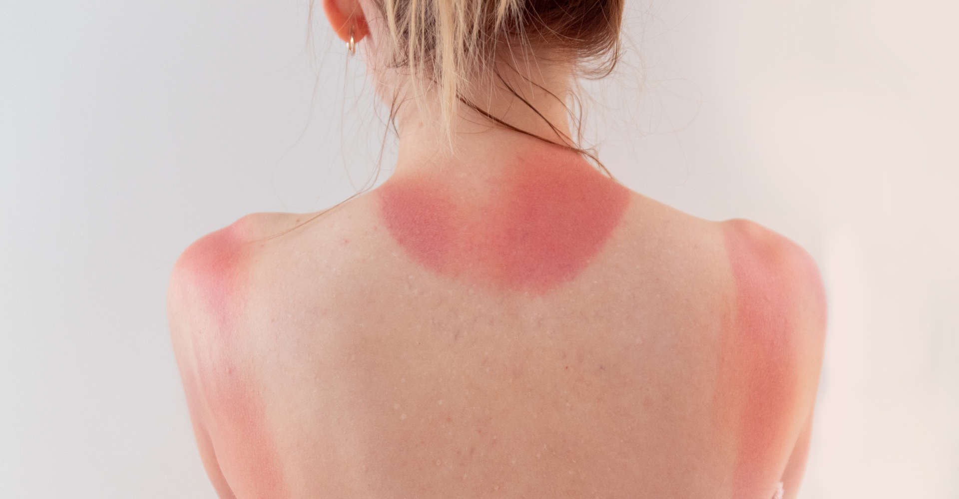 mulher exite marcas de queimadura causadas pelo sol