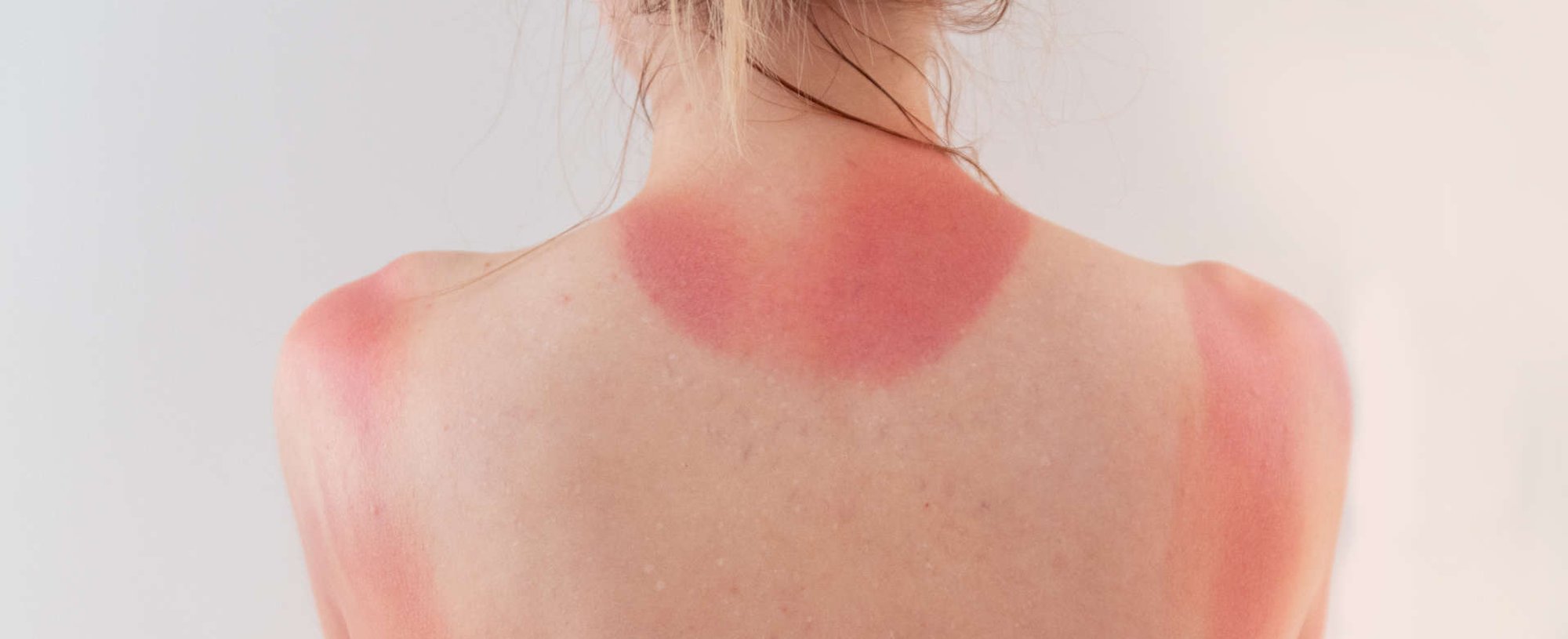 mulher exite marcas de queimadura causadas pelo sol