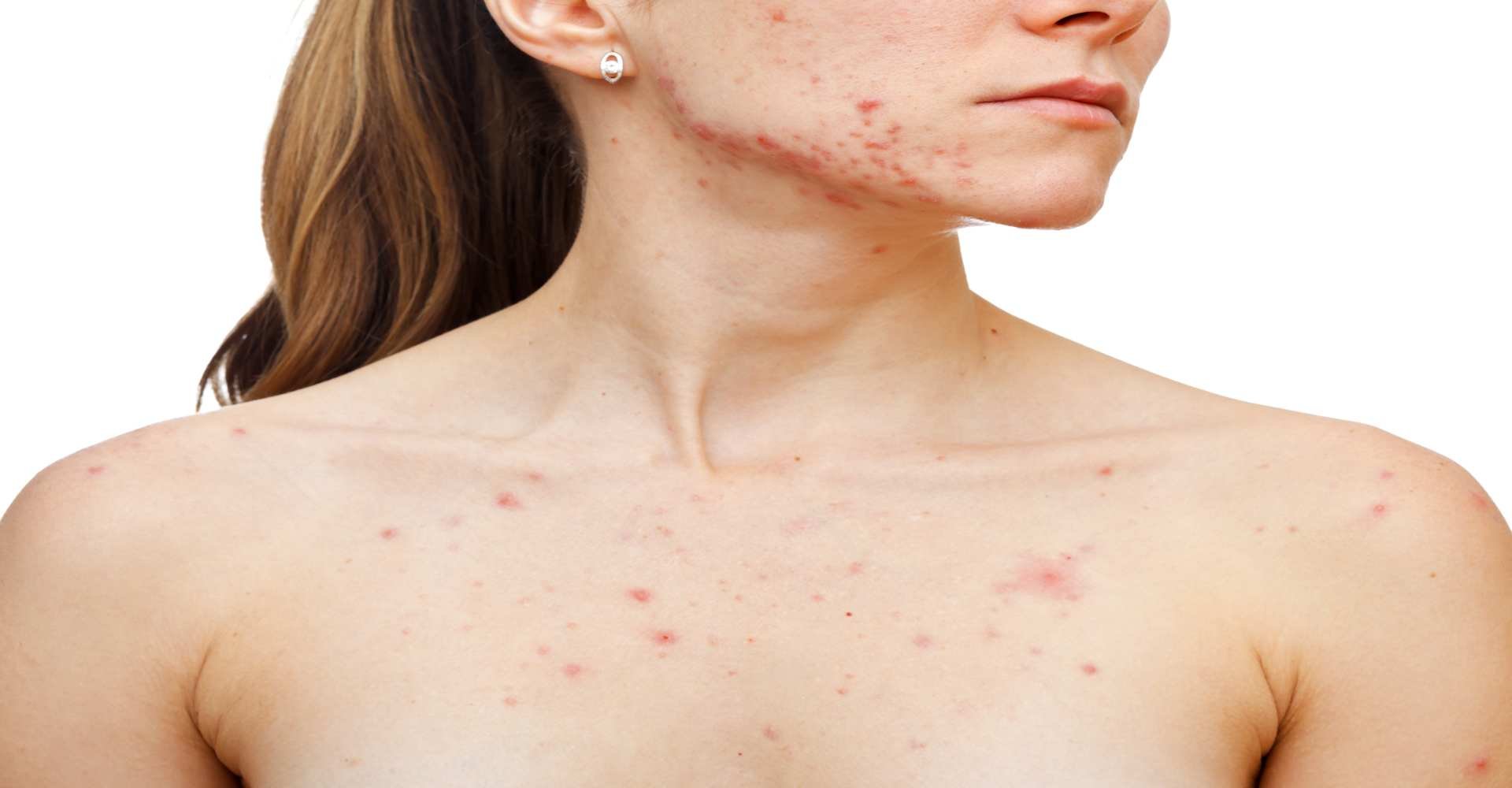 Imagem De Modelo Branca Com Acne No Peito
