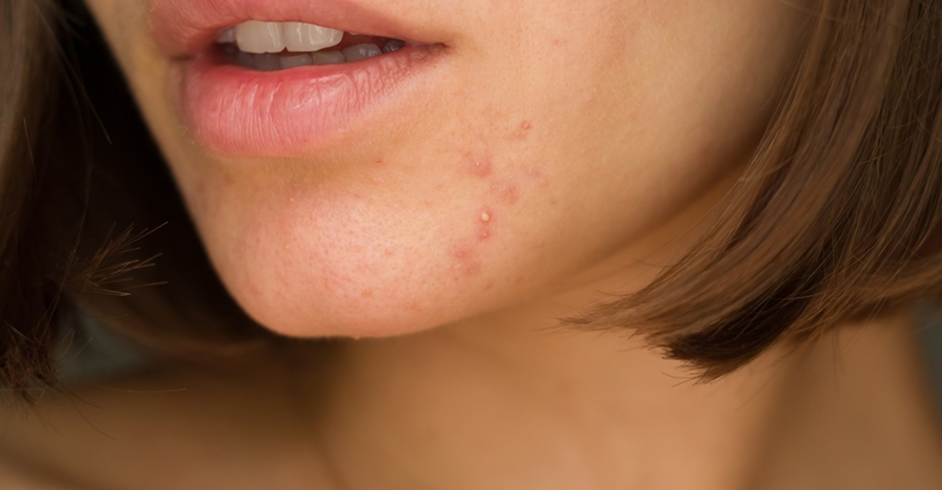 Nao Espremer Espinhas