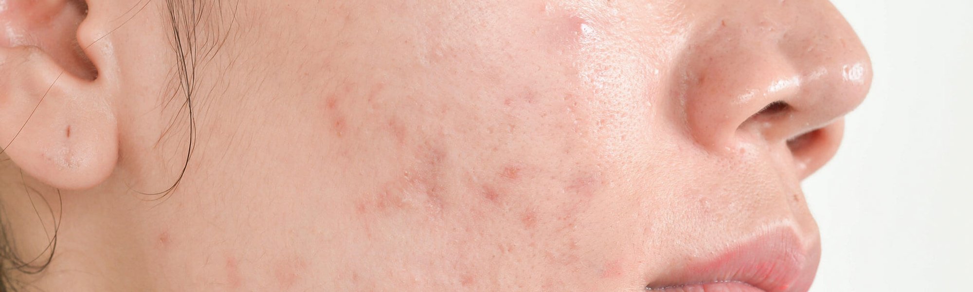 Acne fúngica: o que é e como tratar? Dermatologista explica | L'Oréal Paris