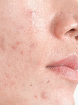 Acne fúngica: o que é e como tratar? Dermatologista explica | L'Oréal Paris