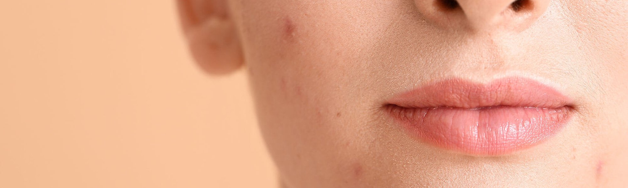 Acne hormonal: o que é e quais são os tratamentos? | L'Oréal Paris