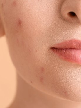 Acne hormonal: o que é e quais são os tratamentos? | L'Oréal Paris