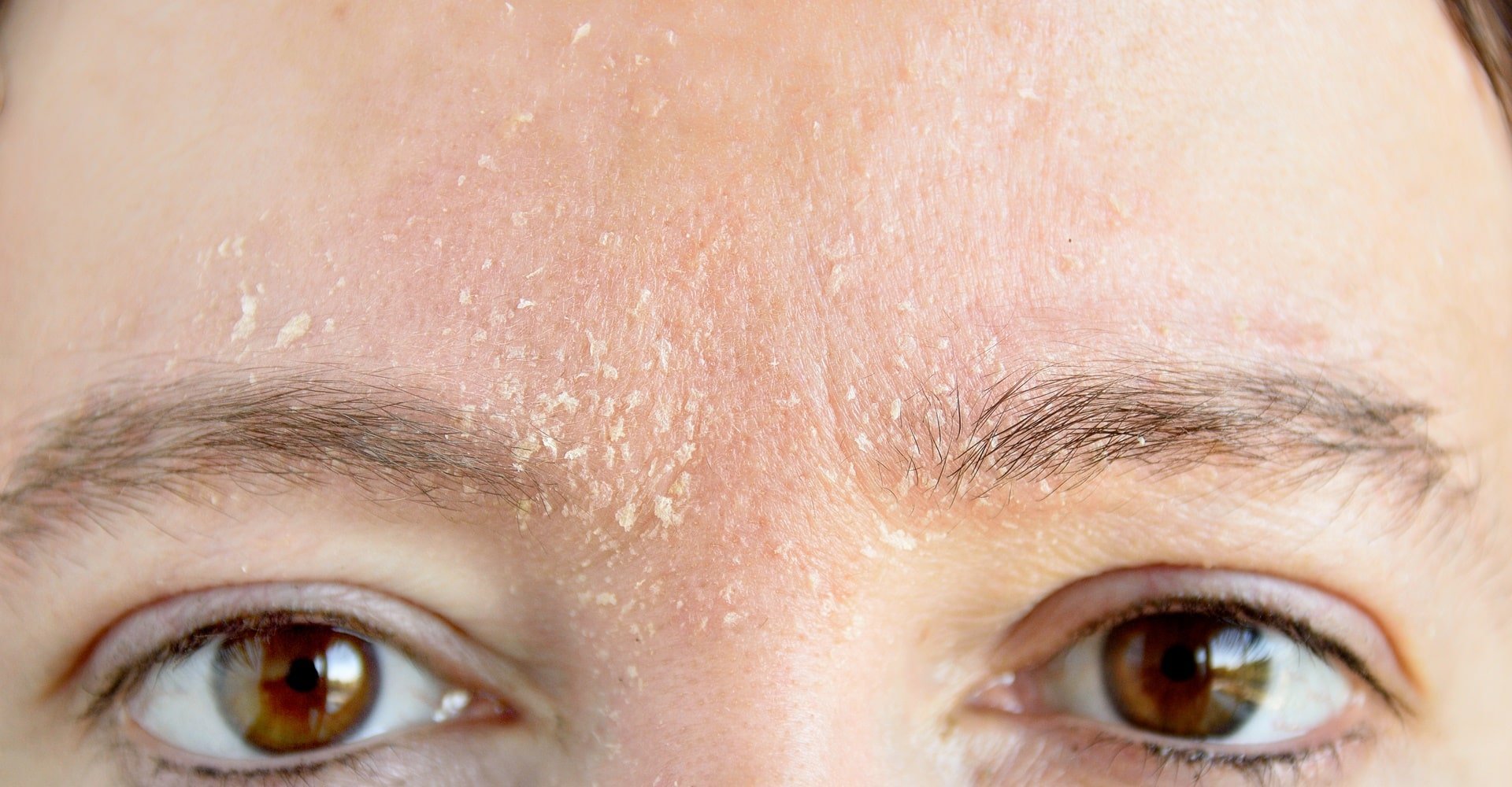 Saiba de como cuidar da pele seca