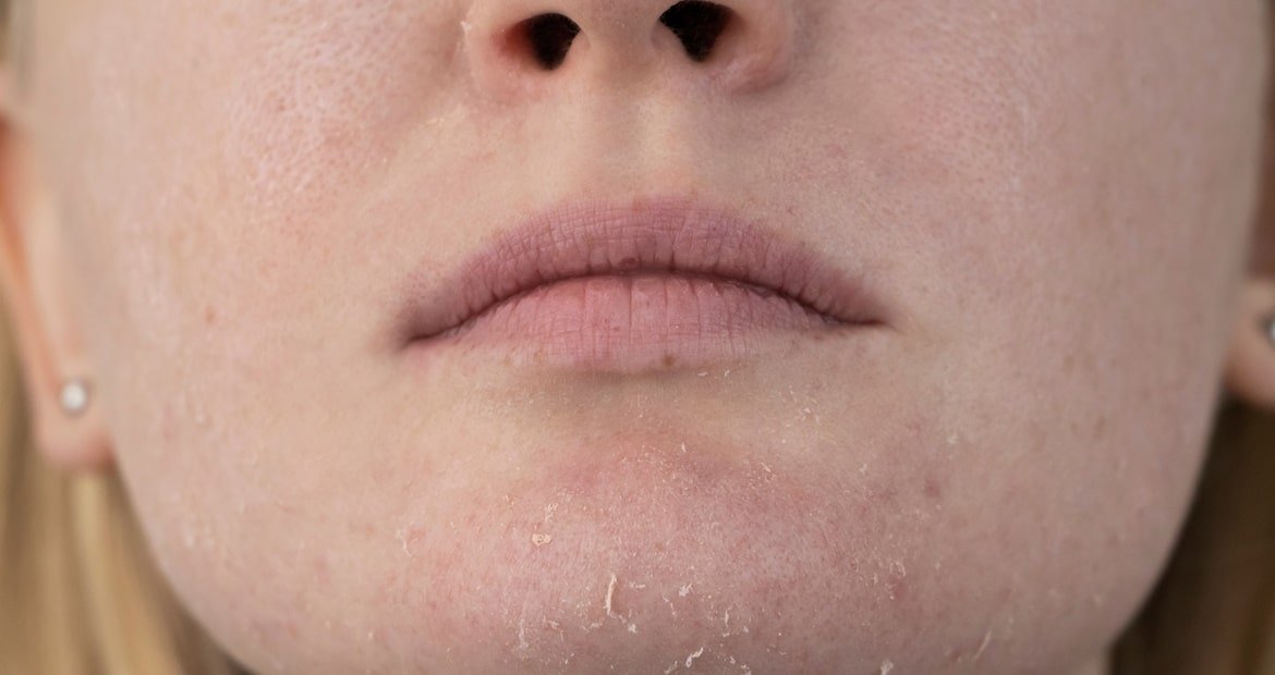 Pele seca quais as características e como cuidar? BLOG POST